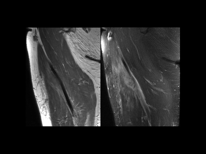 Figure 2 for case myositis ossificans